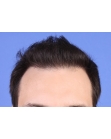 After Hair Transplant &nbsp;Front
